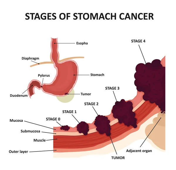 Стадии рака желудка. Классификация злокачественных опухолей . — стоковый вектор