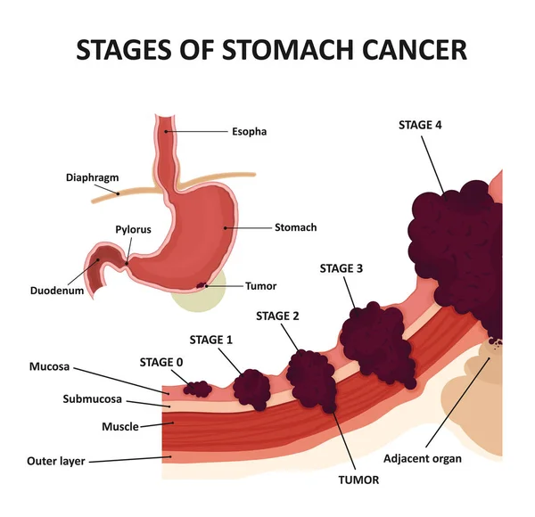 Mide kanseri aşamaları. Malign tümör sınıflandırılması. — Stok Vektör