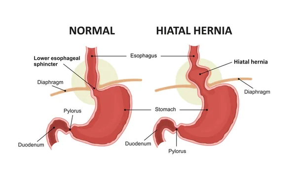 Hiatus hernia és a gyomor normális anatómiája — Stock Vector