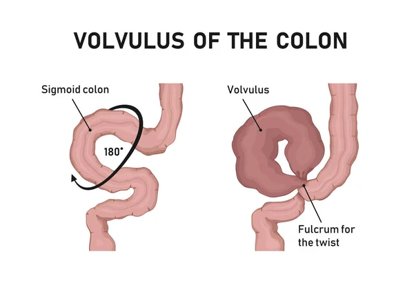 Volvulus Του Παχέος Εντέρου — Διανυσματικό Αρχείο