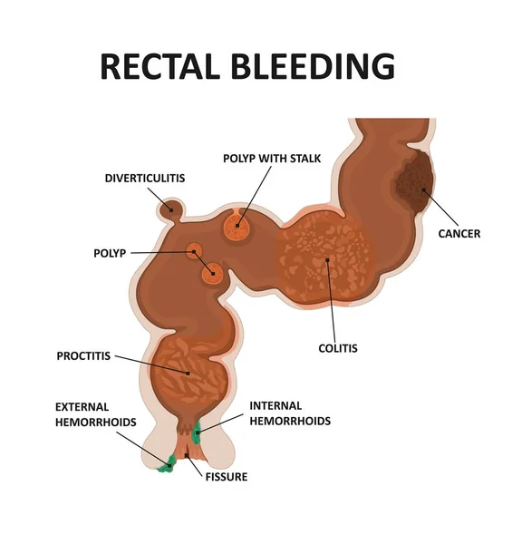 Causa sangrado rectal . — Vector de stock