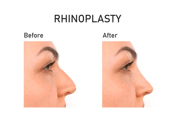 Woman before and after rhinoplasty — Stock Photo, Image