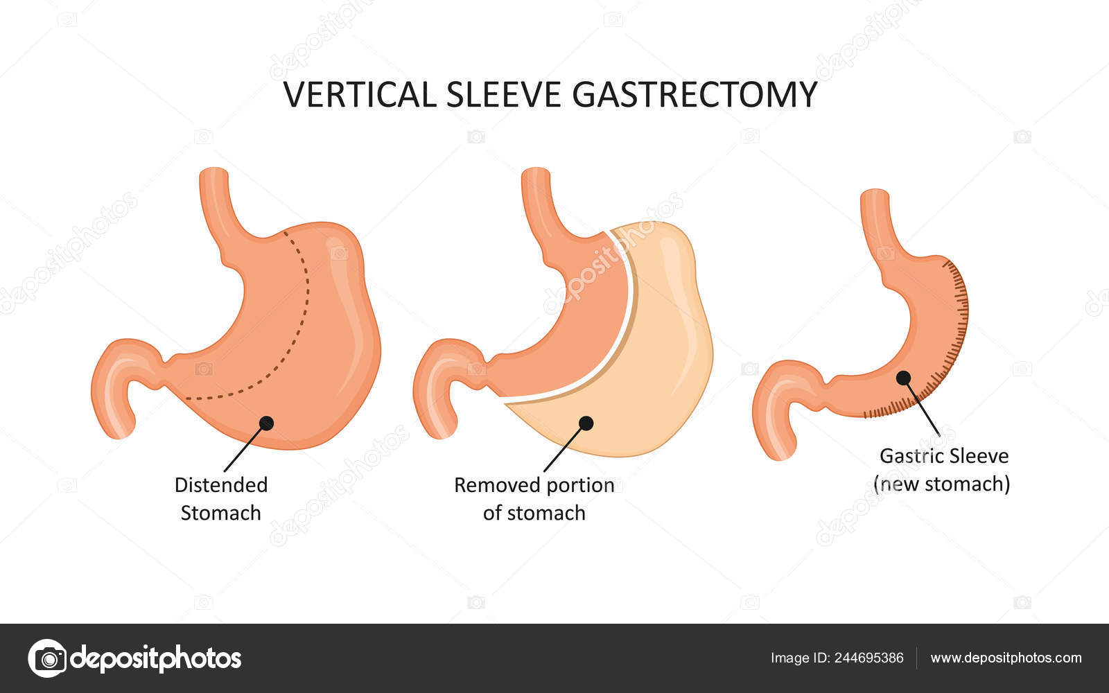 Гастрэктомия желудка диета без спорта Гастрэктомия желудка диета без спорта