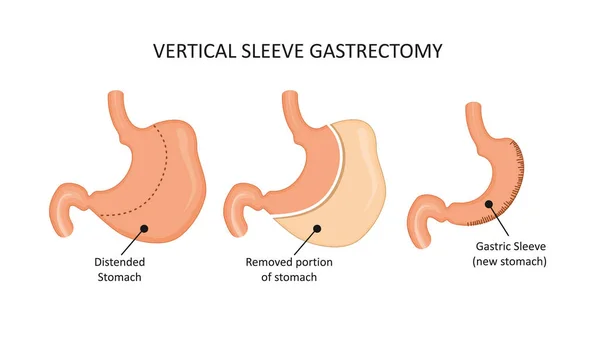 Vertikální sleeve gastrektomii. Snížení operaci žaludku — Stockový vektor