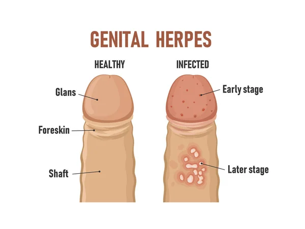 Herpes genital. pênis saudável e infectado — Vetor de Stock