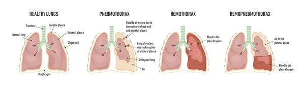 Pulmones humanos con neumotórax, hemotórax y hemopneumotórax — Vector de stock