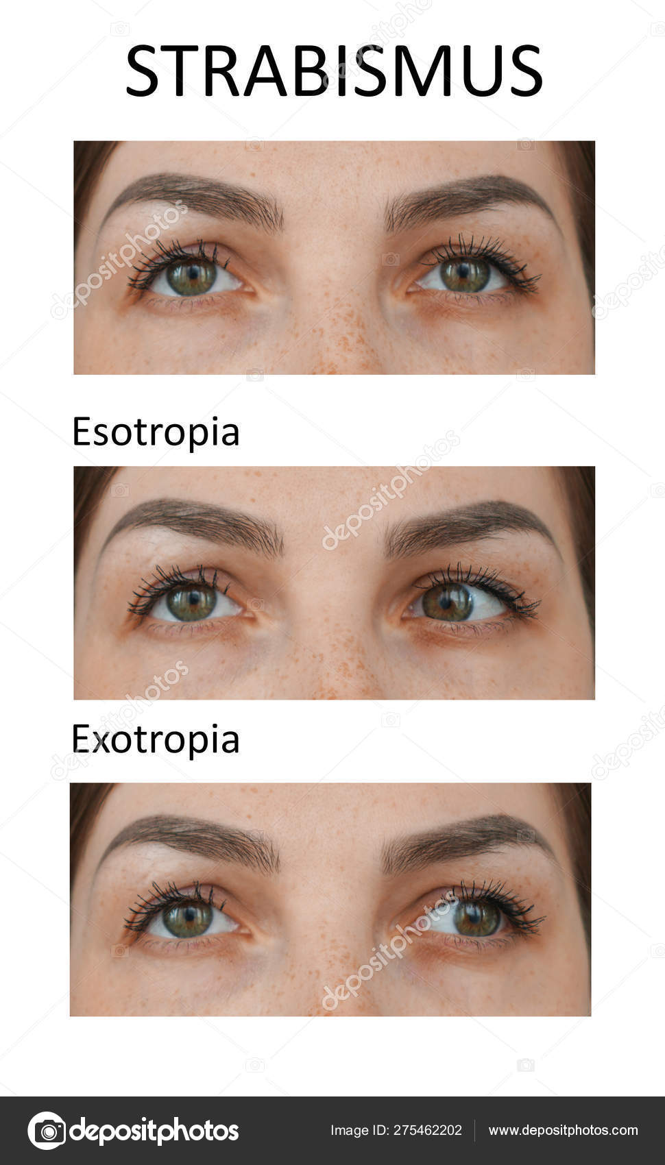 Types Of Strabismus Esotropia And Exotropia Stock Photo By C Nnfotograf Types Of Strabismus Esotropia And Exotropia Stock Photo By C Nnfotograf