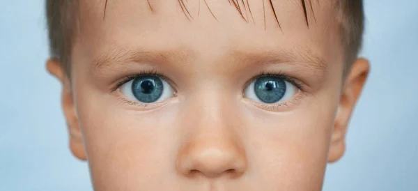 Uma criança com sintomas de doença oftalmológica Anisocoria . — Fotografia de Stock