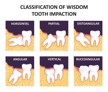 Bilgelik diş impaction sınıflandırılması