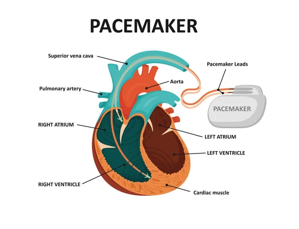Mänskligt hjärta med pacemaker. Konditions implantat — Stock vektor