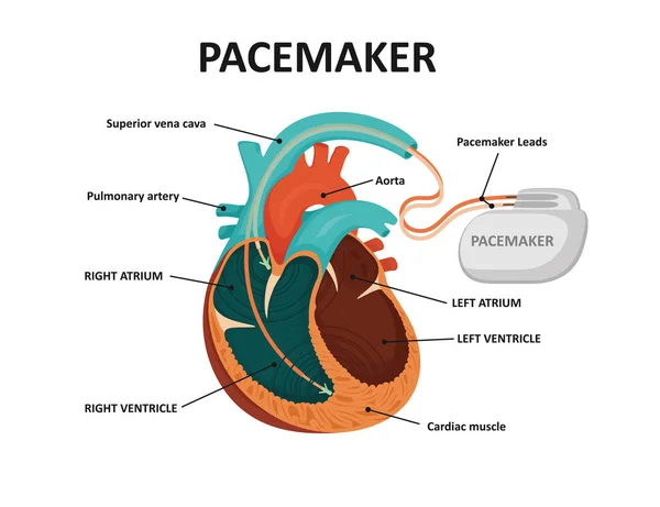 Serce ludzkie z rozrusznikiem serca. Implanty cardio — Wektor stockowy