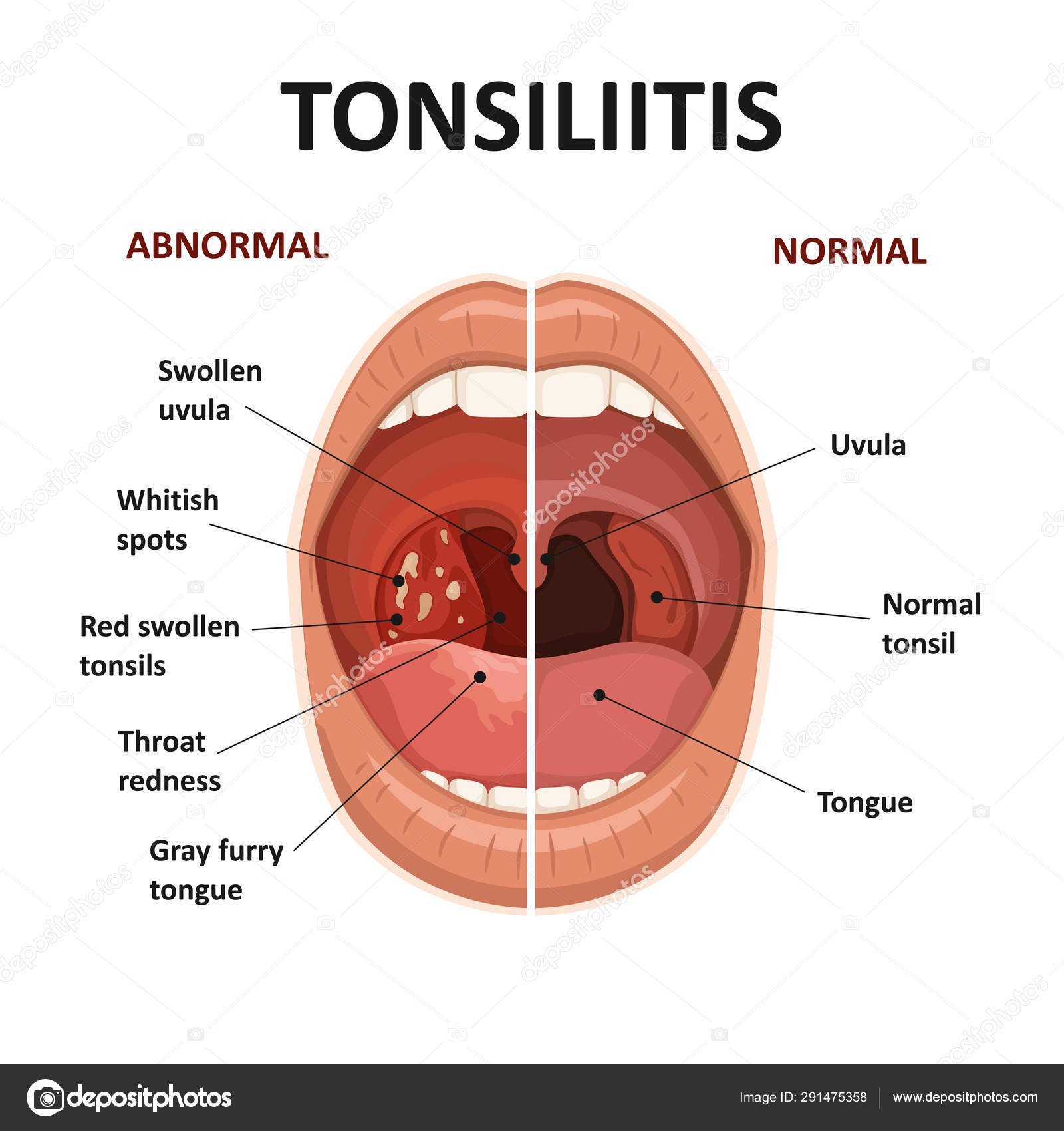 török prostatitis