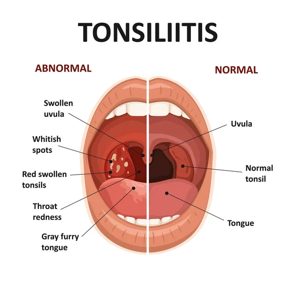 Amandelen en keelziekten. Tonsillitis symptomen. Anatomie van de menselijke mond. — Stockvector