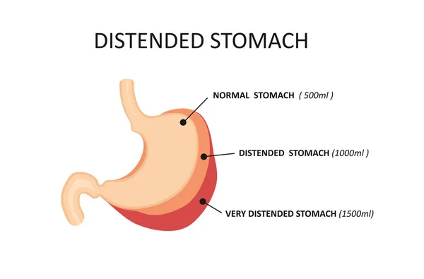 Stomaco per obesità. Stretching stomaco durante l'eccesso di cibo. Distensione dello stomaco — Vettoriale Stock