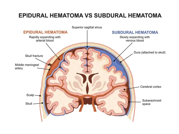 Ematoma epidurale vs ematoma subdurale — Vettoriale Stock