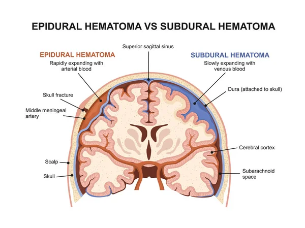 경막외 혈종 대 경막하 혈종 — 스톡 벡터