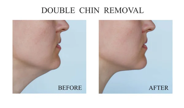 Woman double chin before and after procedures. Close up view — Stock Photo, Image