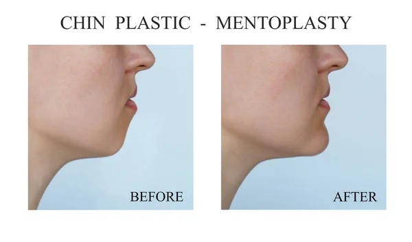 Chin Plastic before and after procedures. Mentoplasty — Stock Photo, Image