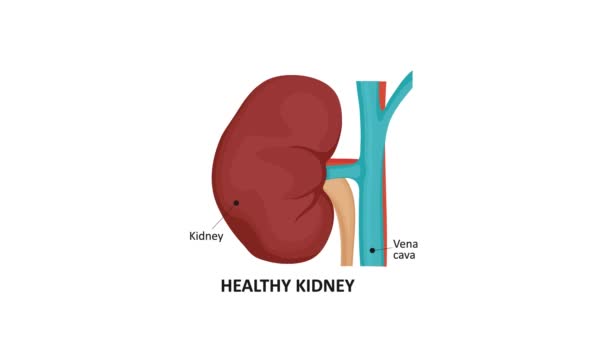 Animatie ter illustratie van de verschillende stadia van nierkanker. — Stockvideo