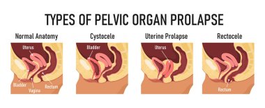 Types of pelvic organ prolapse - cystocele, uterine prolapse, rectocele clipart