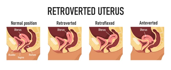Utérus rétroverti. Diagramme pour les variantes de position utérine — Image vectorielle