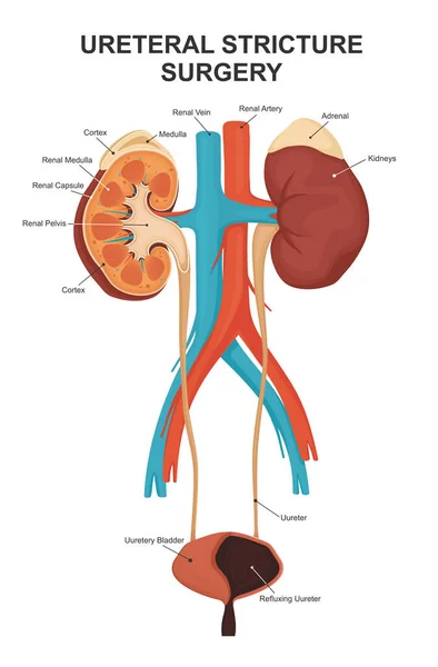 Cirurgia de estenose ureteral. A estrutura dos rins, a glândula adrenal e a bexiga —  Vetores de Stock