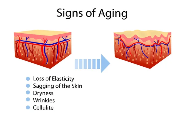 Vector diagram met tekenen van veroudering, twee soorten huid, voor cosmetological en gezondheidszorg illustraties — Stockvector