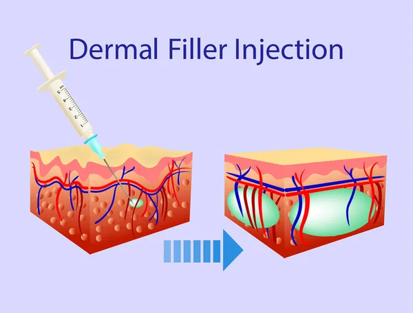 Vectorillustratie met cosmetische vuller of dermale vullers op blauwe achtergrond — Stockvector