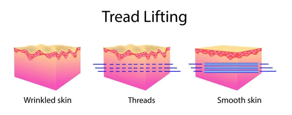 Thread tillen, vector illustratie en huidcellen, voordat na effect — Stockvector