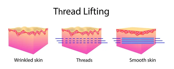 Fadenlifting, Vektor-Illustration und Hautzellen, bevor sie nachwirken — Stockvektor