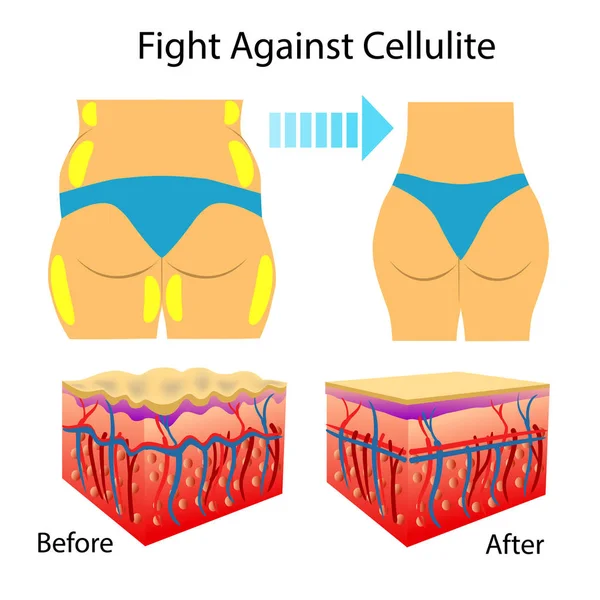 Ilustração vetorial de dois tipos de pele mostrando celulite, isolada — Vetor de Stock