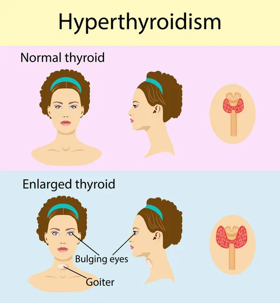 Mulher com aumento da glândula hipertiroide. Ilustração vetorial . —  Vetores de Stock