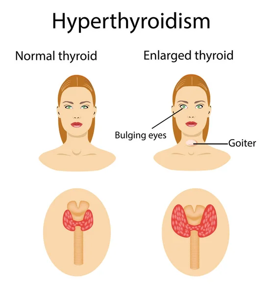 Mulher com aumento da glândula hipertiroide. Ilustração vetorial . —  Vetores de Stock