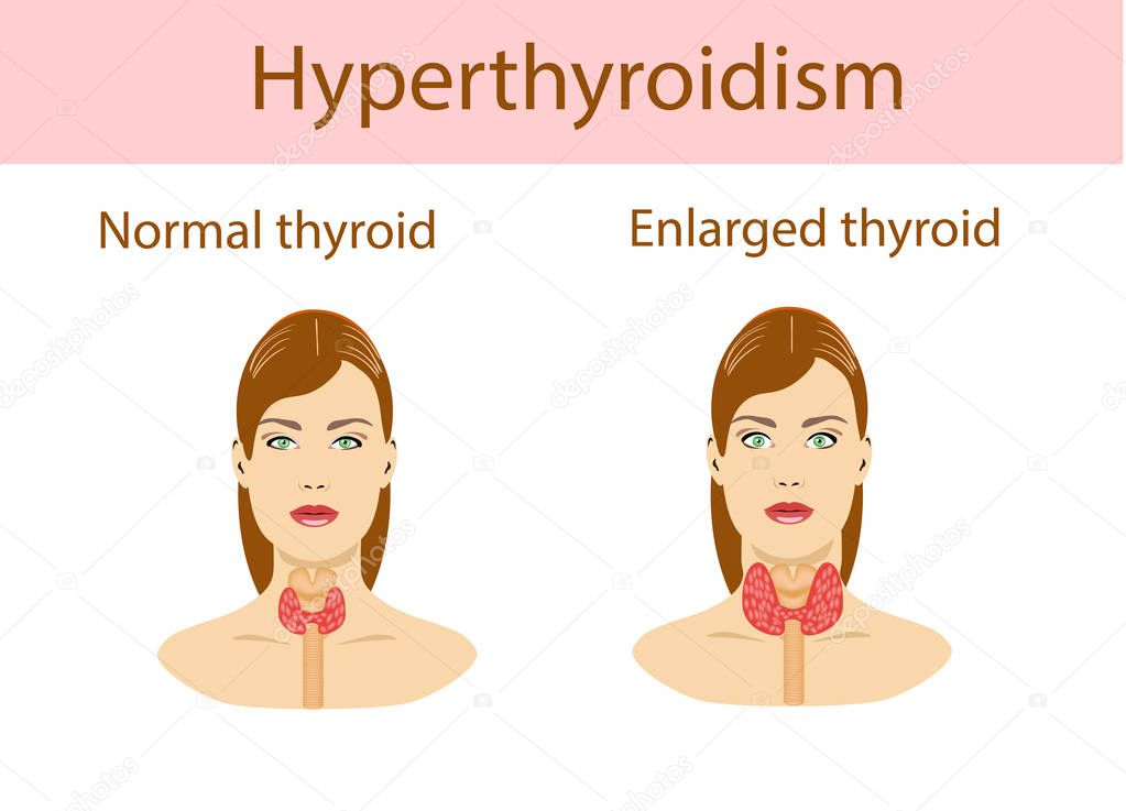 Woman with enlarged hyperthyroid gland. Vector illustration.