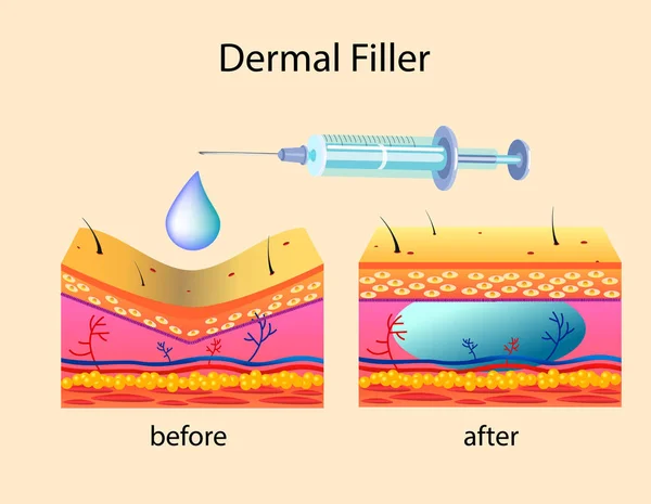 Illustrazione vettoriale con filler cosmetico o filler dermici su sfondo chiaro — Vettoriale Stock