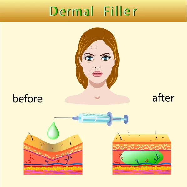 Vektorillustration med kosmetiska filler eller Dermal fillers på ljus bakgrund — Stock vektor