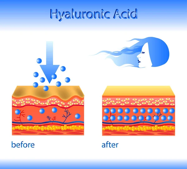 Ilustrasi vektor dengan pengisi kosmetik atau asam Hyaluronat pada latar belakang cahaya - Stok Vektor