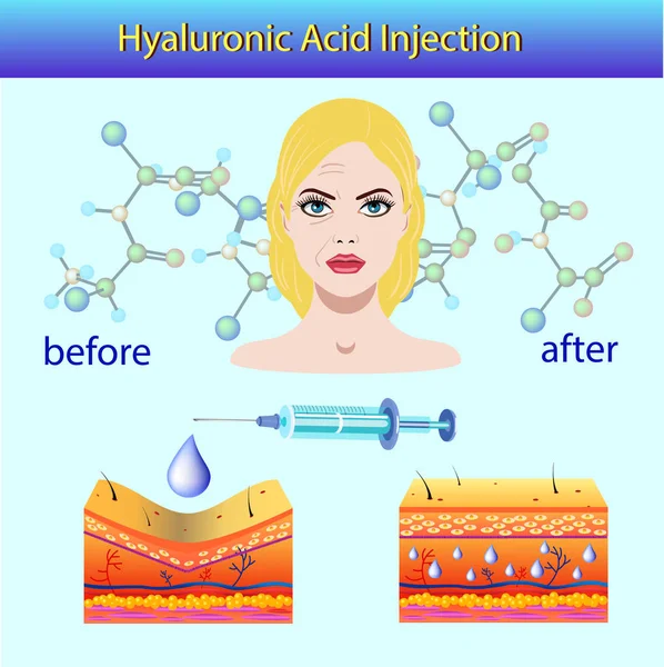 Vektorillustration med kosmetiska filler eller Dermal fillers på ljus bakgrund — Stock vektor