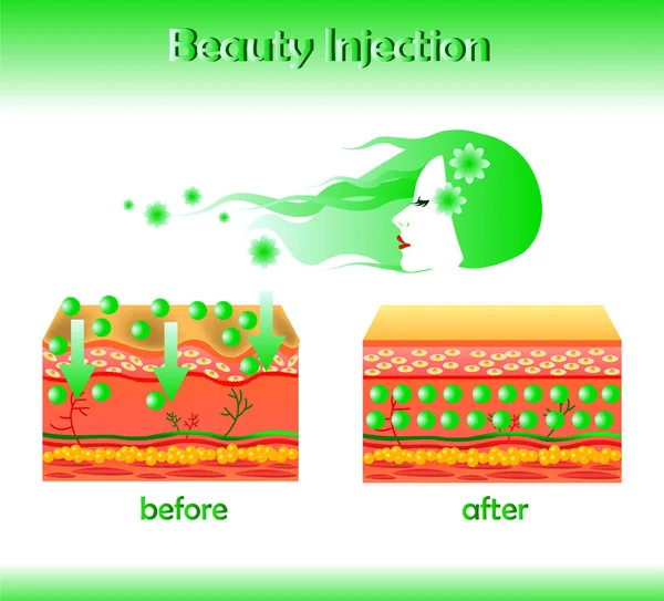 Ilustración vectorial con relleno cosmético o ácido hialurónico sobre fondo claro — Vector de stock