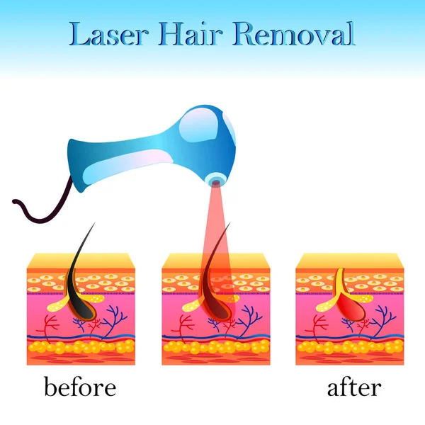 Laser hårborttagning, struktur av cellen och en laser apparater — Stock vektor