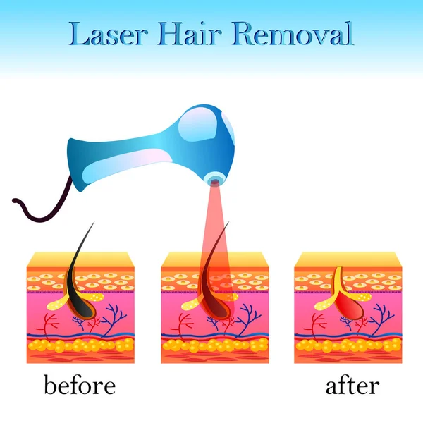Depilación láser, estructura de la célula y un aparato láser — Archivo Imágenes Vectoriales
