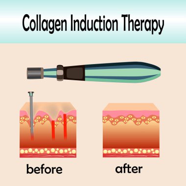 Önce sonra etkisi, Microneedle damgalama aygıt, kollajen indüksiyon tedavisi