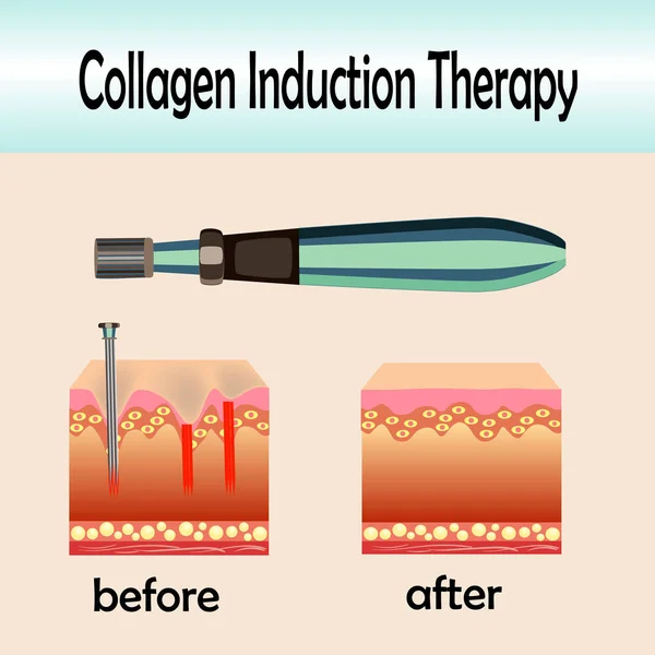 Antes del efecto posterior, dispositivo de estampación de microneedle, terapia de inducción de colágeno — Vector de stock