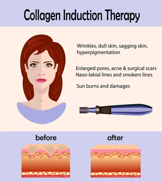 Antes del efecto posterior, dispositivo de estampación de microneedle, terapia de inducción de colágeno — Vector de stock