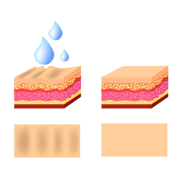 Illustrazione vettoriale con filler cosmetico o filler dermici su sfondo bianco — Vettoriale Stock