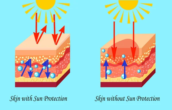 Two types of skin with and without sun protection, sunburn, vector illustration — Stock Vector