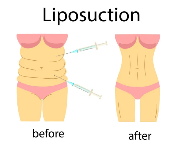 Liposuction önce ve sonra etkisi, Fitness veya diyet. Vektör Illustration kadın rakam — Stok Vektör