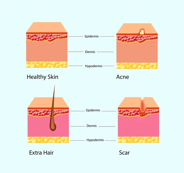 Векторні ілюстрації типів проблем шкіри ізольовані — стоковий вектор