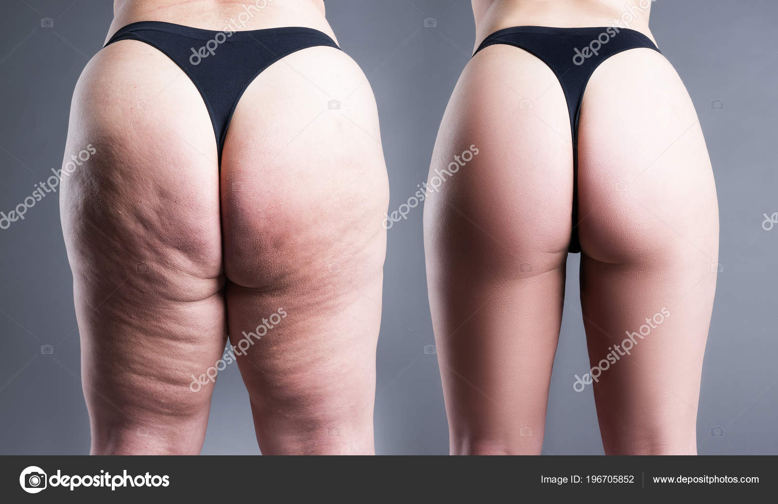 Como emagrecer pernas gordas