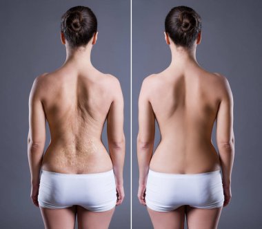 Woman with large scar on the back, before after concept, rear view on gray background clipart
